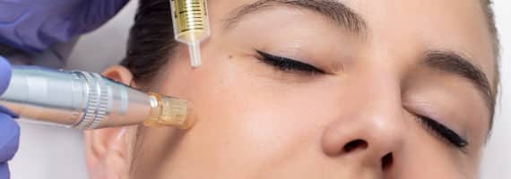 Kosmetische Behandlung Microneedling im Kosmetikstudio Remscheid