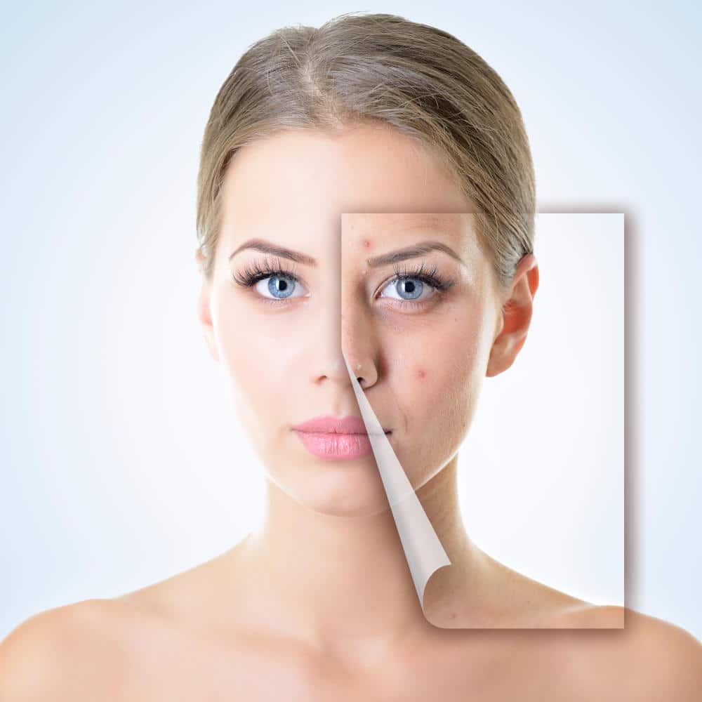 Gesichtsreinigung bei Problemhaut, unreine Haut, Akne