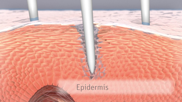 Schmatische Darstellung: Microneedling und Epidermis